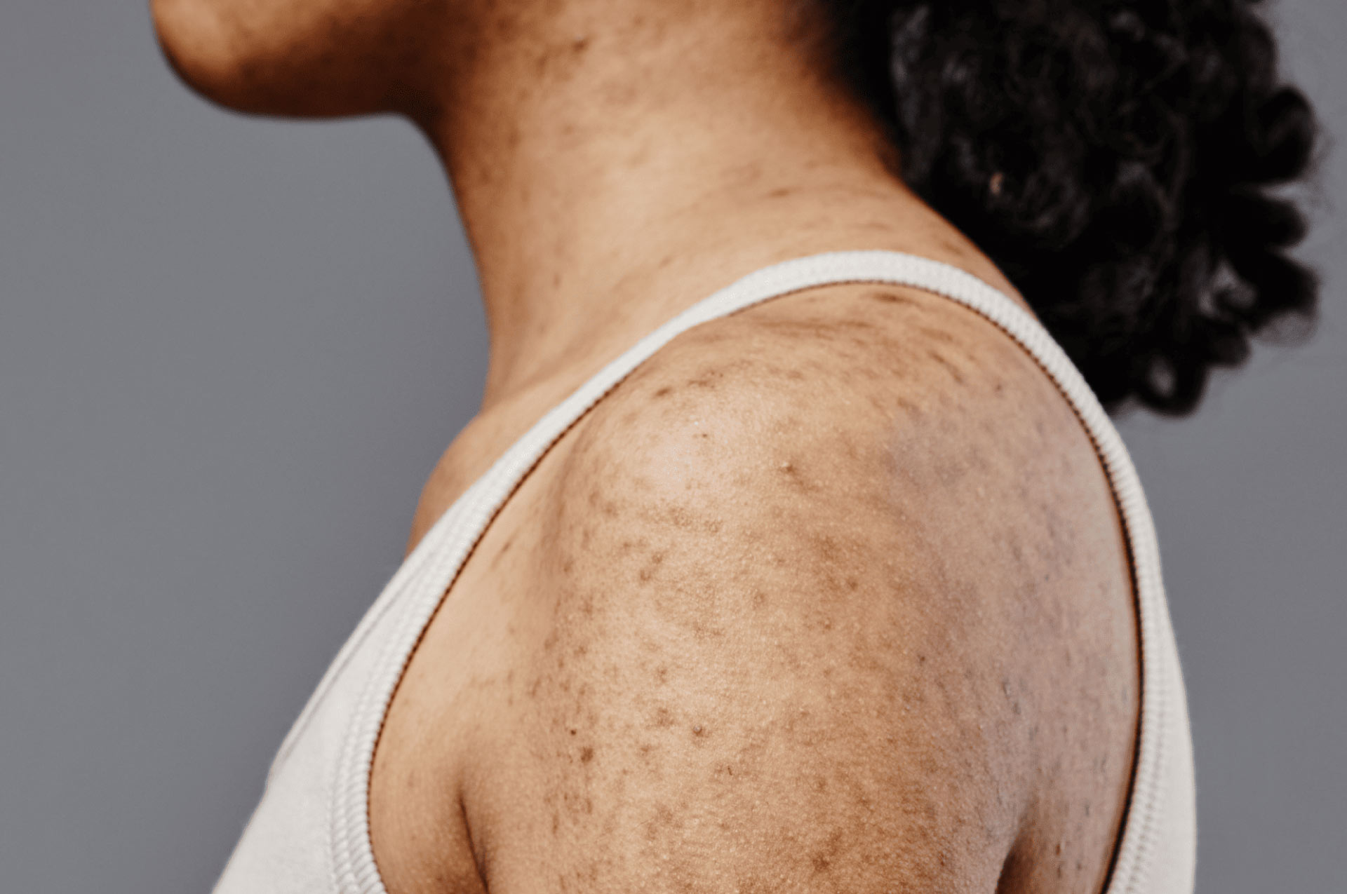 hyperpigmentation-on-the-body